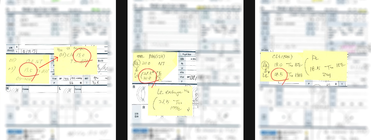 Cataract Surgery and Lens Implant in Korea Samsung Miracle eye clinic seoul