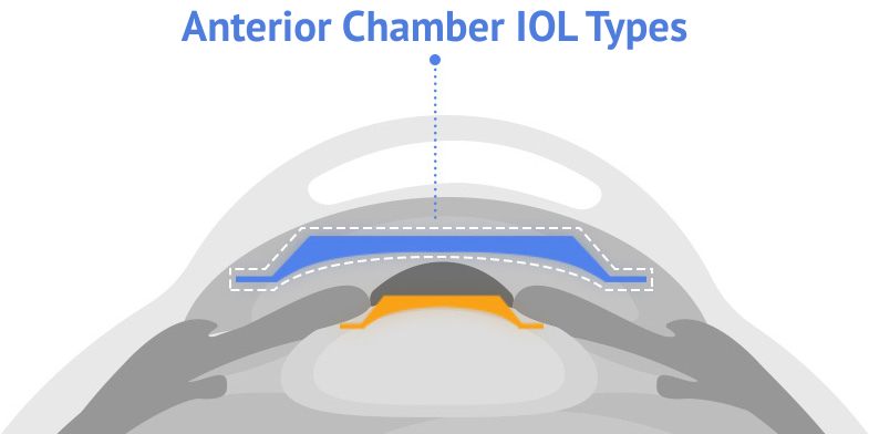 types of icl implants in korea Samsung Miracle eye clinic seoul