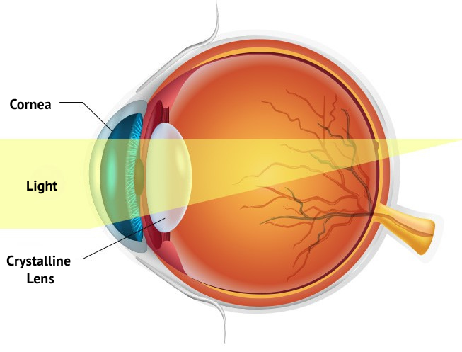 Cataract Surgery and Lens Implant in Korea Samsung Miracle eye clinic seoul