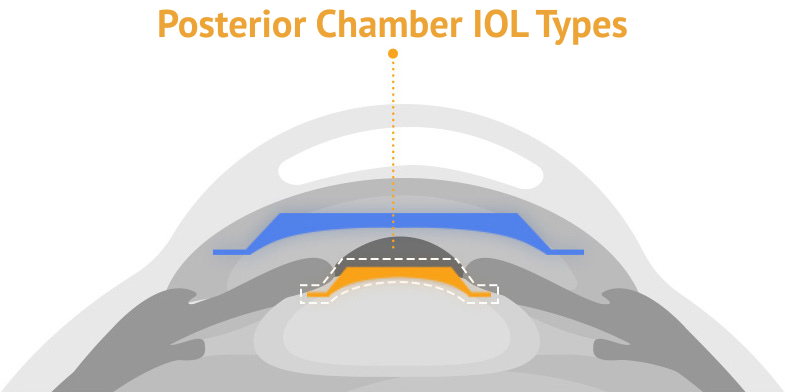 types of icl implants in korea Samsung Miracle eye clinic seoul