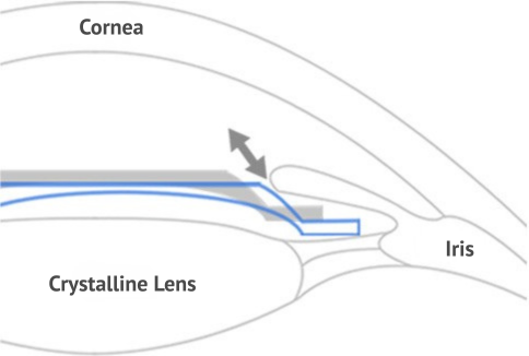 icl implants in korea Samsung Miracle eye clinic seoul