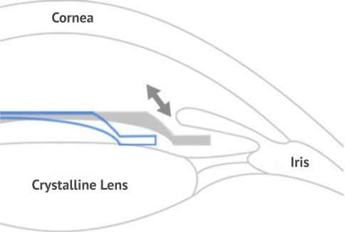 icl implants in korea Samsung Miracle eye clinic seoul