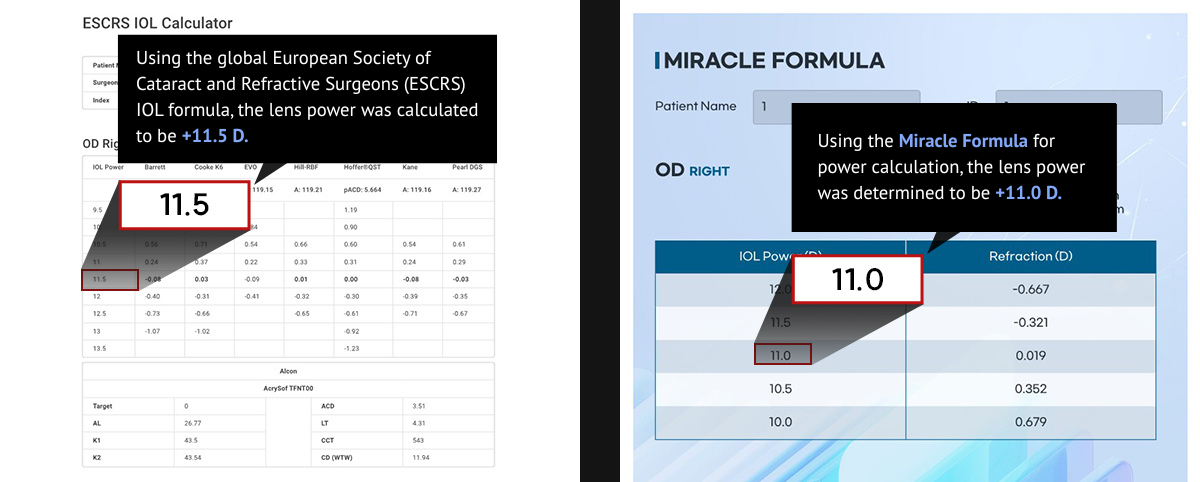 Cataract Surgery and Lens Implant in Korea Samsung Miracle eye clinic seoul