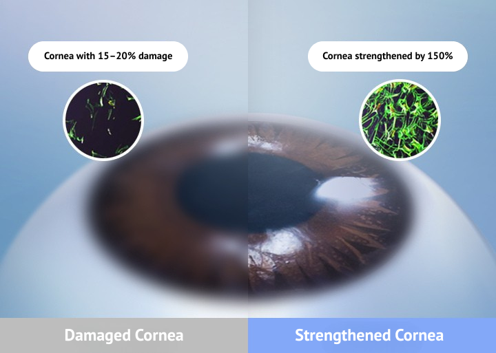 corneal cross-linking in korea Samsung Miracle eye clinic seoul
