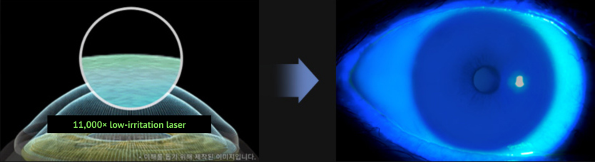 smile laser eye surgery research in Korea Samsung Miracle eye clinic seoul