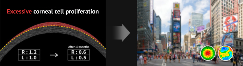 smile laser eye surgery research in Korea Samsung Miracle eye clinic seoul