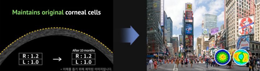 smile laser eye surgery research in Korea Samsung Miracle eye clinic seoul