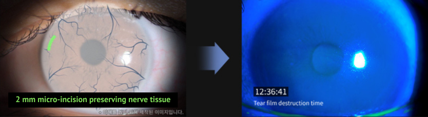 smile laser eye surgery research in Korea Samsung Miracle eye clinic seoul