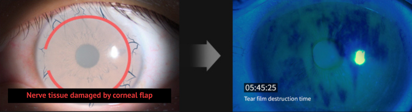 smile laser eye surgery research in Korea Samsung Miracle eye clinic seoul