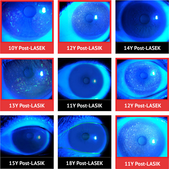 smile laser eye surgery research in Korea Samsung Miracle eye clinic seoul