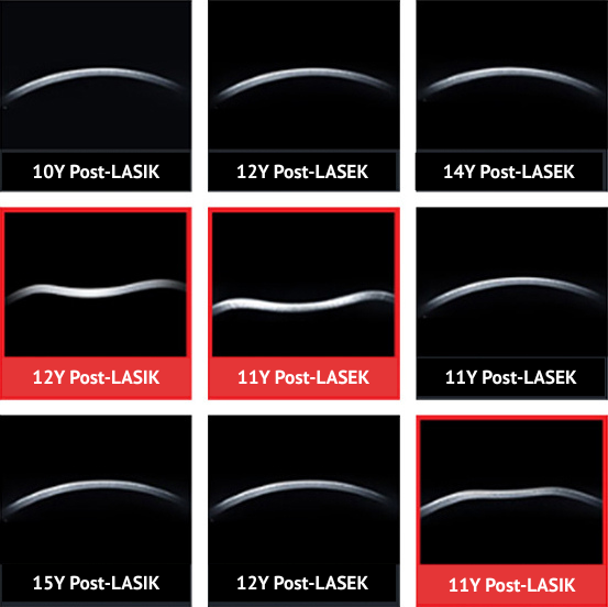 smile laser eye surgery research in Korea Samsung Miracle eye clinic seoul