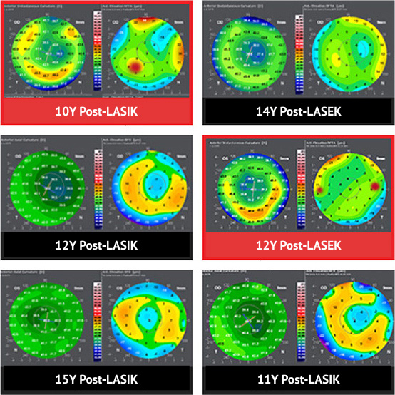 smile laser eye surgery research in Korea Samsung Miracle eye clinic seoul