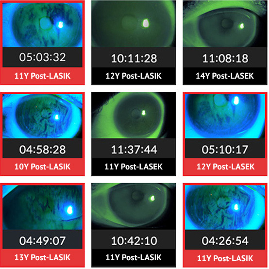 smile laser eye surgery research in Korea Samsung Miracle eye clinic seoul