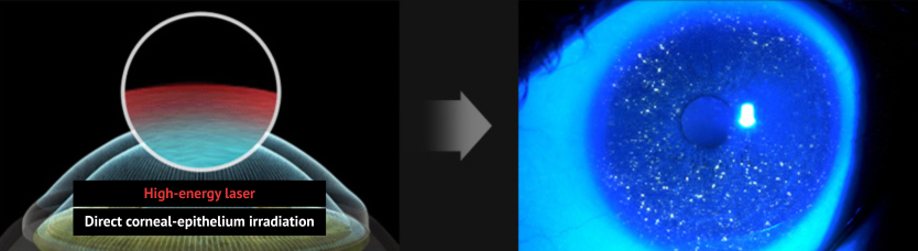 smile laser eye surgery research in Korea Samsung Miracle eye clinic seoul