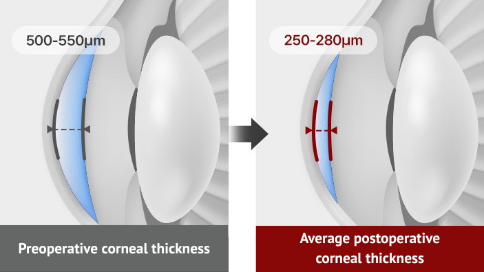 Samsung Miracle eye clinic in korea seoul